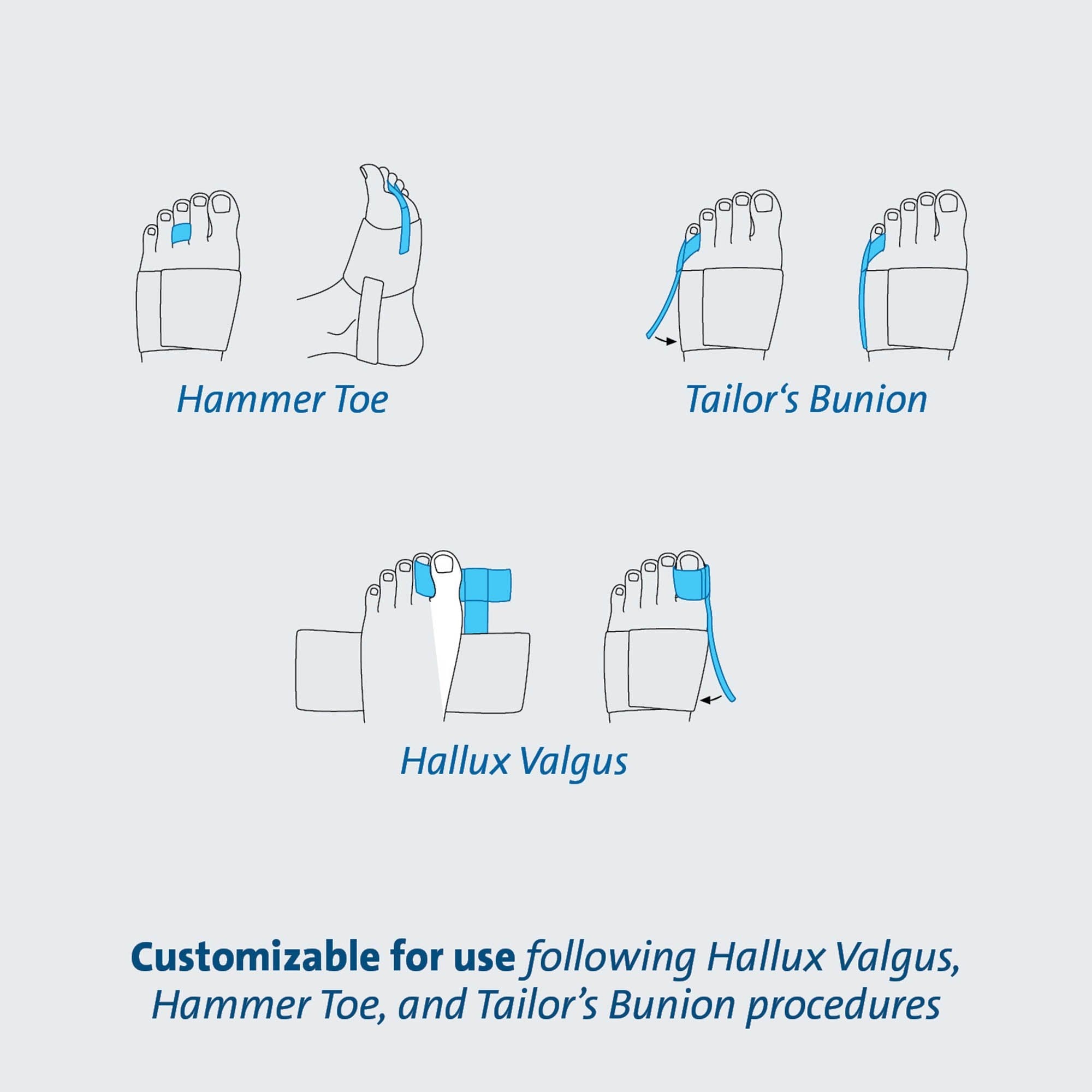 TAS™ Toe Splint, One Size Fits Most TAS